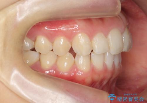 出っ歯に見える前歯の改善 部分ワイヤーとマウスピース矯正の治療中