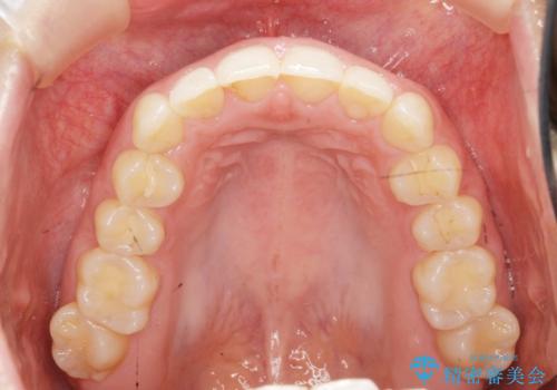 出っ歯に見える前歯の改善 部分ワイヤーとマウスピース矯正の治療中