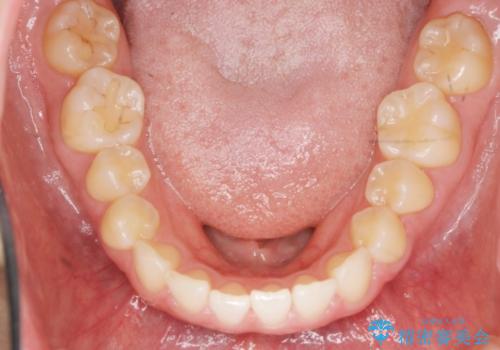 出っ歯に見える前歯の改善 部分ワイヤーとマウスピース矯正の治療中