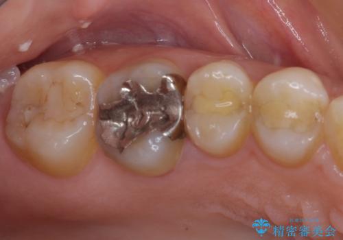 割れてしまった奥歯 インプラント治療の治療前
