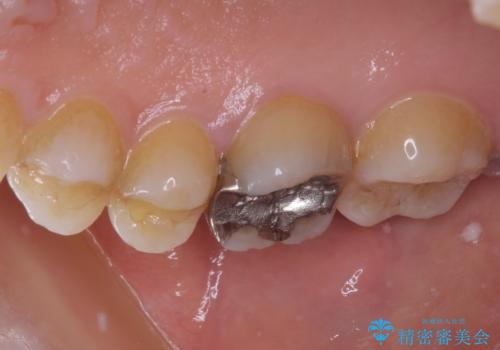 割れてしまった奥歯 インプラント治療の治療前