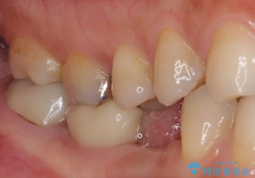 割れてしまった奥歯 インプラント治療の治療前