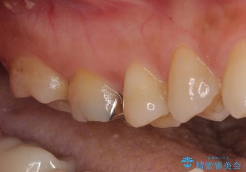 割れてしまった奥歯 インプラント治療の治療前