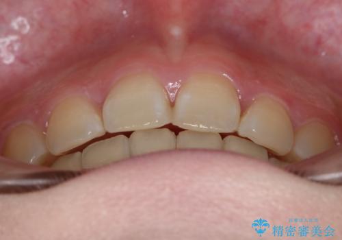 【抜歯】ハーフリンガル矯正で韓国美人な横顔へ!の治療後