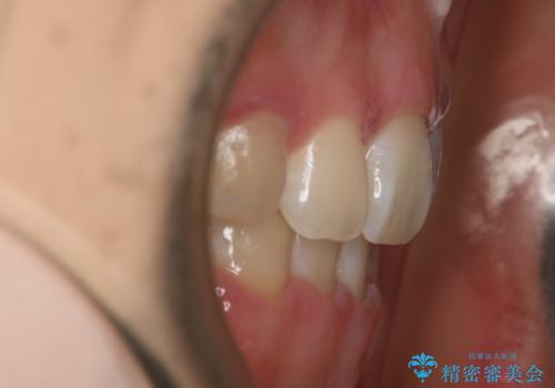 【抜歯】ハーフリンガル矯正で韓国美人な横顔へ!の治療後