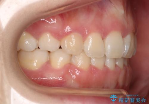 【抜歯】ハーフリンガル矯正で韓国美人な横顔へ!の治療後