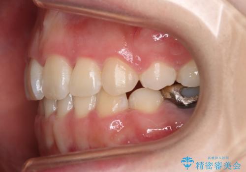 【抜歯】ハーフリンガル矯正で韓国美人な横顔へ!の治療後