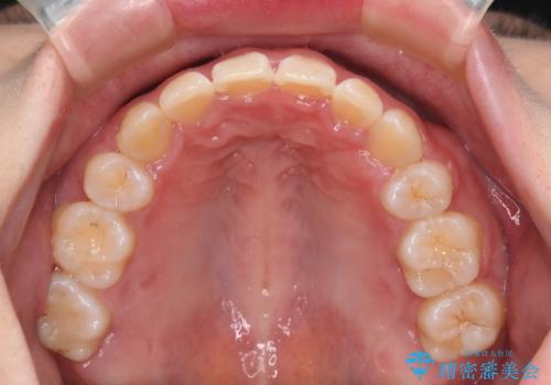 【抜歯】ハーフリンガル矯正で韓国美人な横顔へ!の治療後