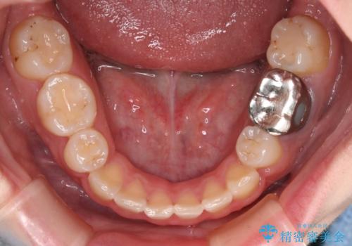 【抜歯】ハーフリンガル矯正で韓国美人な横顔へ!の治療後