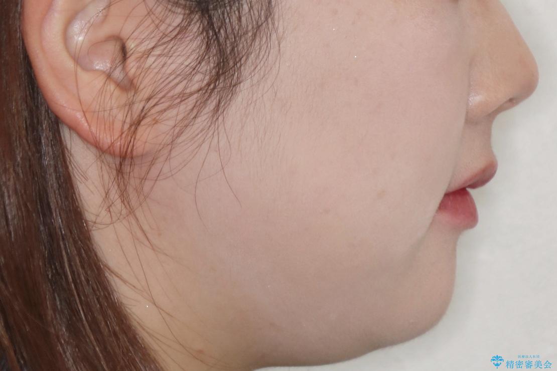 【抜歯】ハーフリンガル矯正で韓国美人な横顔へ!の治療後(顔貌)