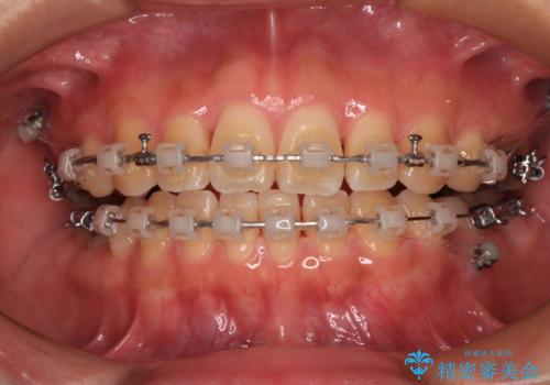 欠損と口元の突出感 ワイヤー装置での抜歯矯正の治療中