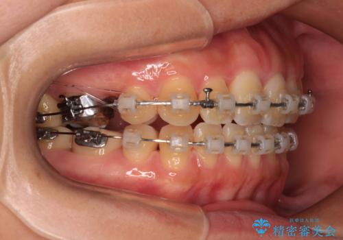 欠損と口元の突出感 ワイヤー装置での抜歯矯正の治療中
