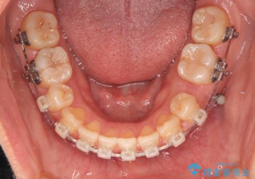 欠損と口元の突出感 ワイヤー装置での抜歯矯正の治療中