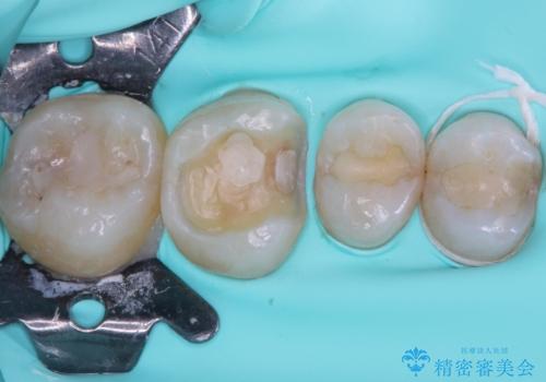 割れてしまった奥歯 インプラント治療の治療中