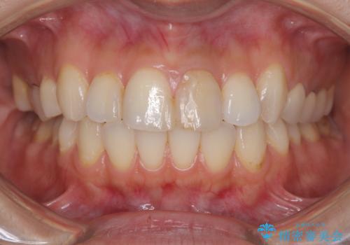 前歯の色が気になる!|オールセラミッククラウンの治療前