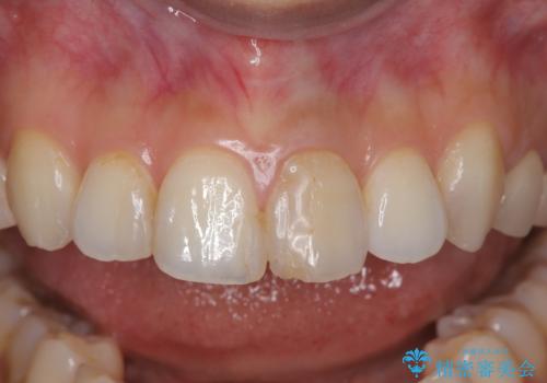 前歯の色が気になる!|オールセラミッククラウンの治療前