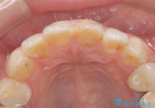 前歯の色が気になる!|オールセラミッククラウンの治療前