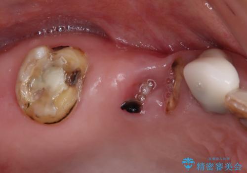 奥歯で噛みたい 破折した歯のインプラント治療の症例 治療前
