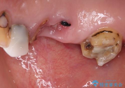 奥歯で噛みたい 破折した歯のインプラント治療の治療前