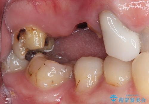 奥歯で噛みたい 破折した歯のインプラント治療の治療前