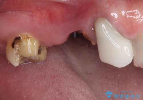 奥歯で噛みたい 破折した歯のインプラント治療の治療前