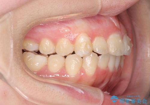 前歯のズレ・がたつき・すれ違いの矯正治療の治療中