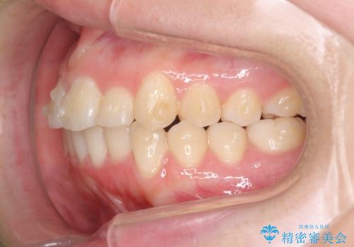 前歯のズレ・がたつき・すれ違いの矯正治療の治療中