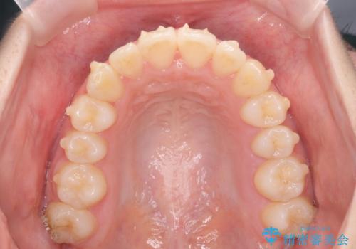 前歯のズレ・がたつき・すれ違いの矯正治療の治療中