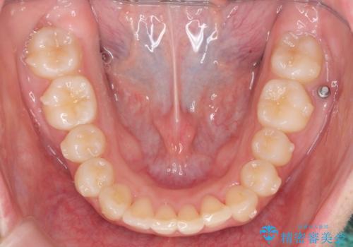 前歯のズレ・がたつき・すれ違いの矯正治療の治療中