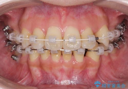 八重歯を矯正治療で治したい!の治療中
