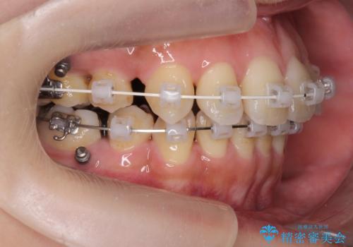 八重歯を矯正治療で治したい!の治療中