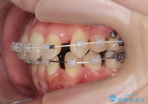 八重歯を矯正治療で治したい!の治療中