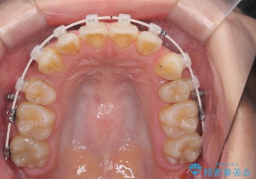 八重歯を矯正治療で治したい!の治療中