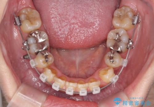 八重歯を矯正治療で治したい!の治療中