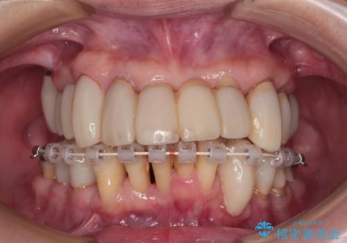 歯周病でグラグラの歯 矯正治療と歯周外科を併用した総合歯科治療の治療中