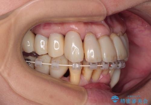 歯周病でグラグラの歯 矯正治療と歯周外科を併用した総合歯科治療の治療中