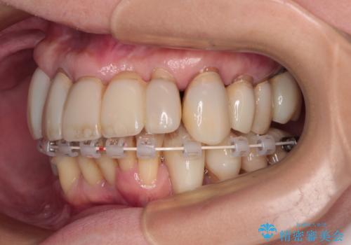 歯周病でグラグラの歯 矯正治療と歯周外科を併用した総合歯科治療の治療中