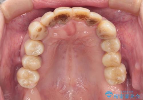 歯周病でグラグラの歯 矯正治療と歯周外科を併用した総合歯科治療の治療中