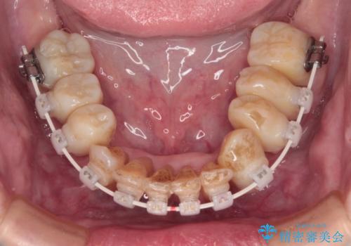 歯周病でグラグラの歯 矯正治療と歯周外科を併用した総合歯科治療の治療中