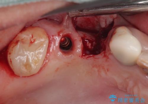 奥歯で噛みたい 破折した歯のインプラント治療の治療前