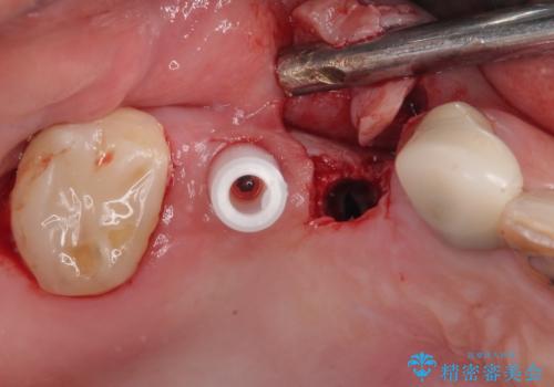 奥歯で噛みたい 破折した歯のインプラント治療の治療中