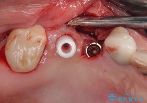 奥歯で噛みたい 破折した歯のインプラント治療の治療後