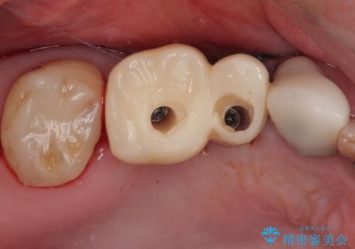 奥歯で噛みたい 破折した歯のインプラント治療の治療中