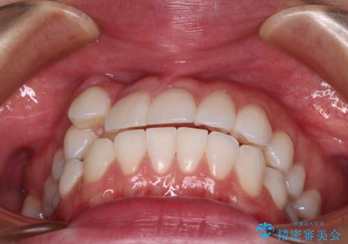 【モニター】八重歯と正中を改善 ワイヤー装置の抜歯矯正の治療前