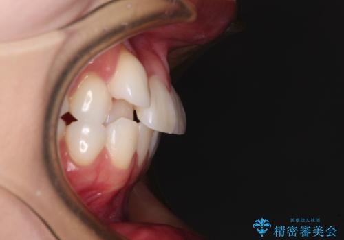 【モニター】八重歯と正中を改善 ワイヤー装置の抜歯矯正の治療前