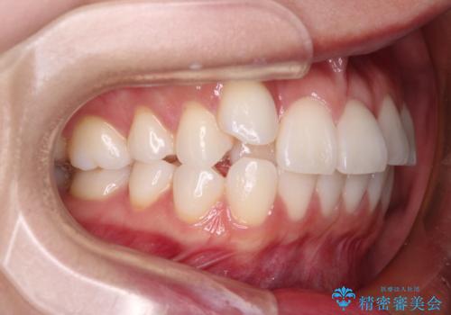 【モニター】八重歯と正中を改善 ワイヤー装置の抜歯矯正の治療前
