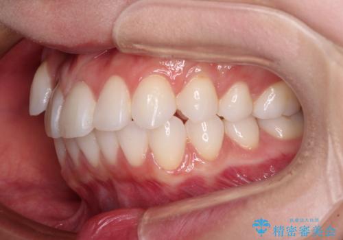 【モニター】八重歯と正中を改善 ワイヤー装置の抜歯矯正の治療前