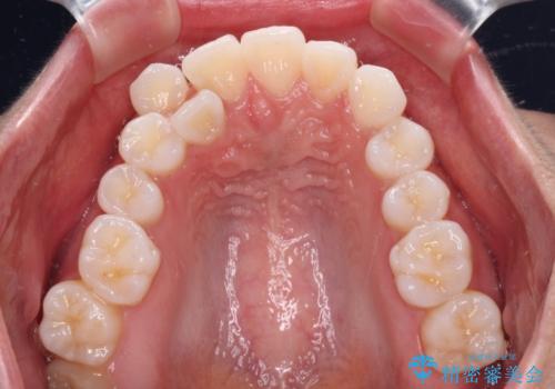 【モニター】八重歯と正中を改善 ワイヤー装置の抜歯矯正の治療前