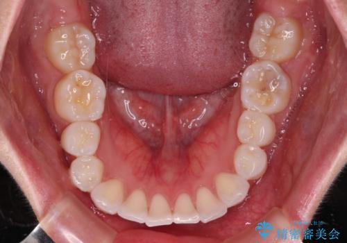 【モニター】八重歯と正中を改善 ワイヤー装置の抜歯矯正の治療前