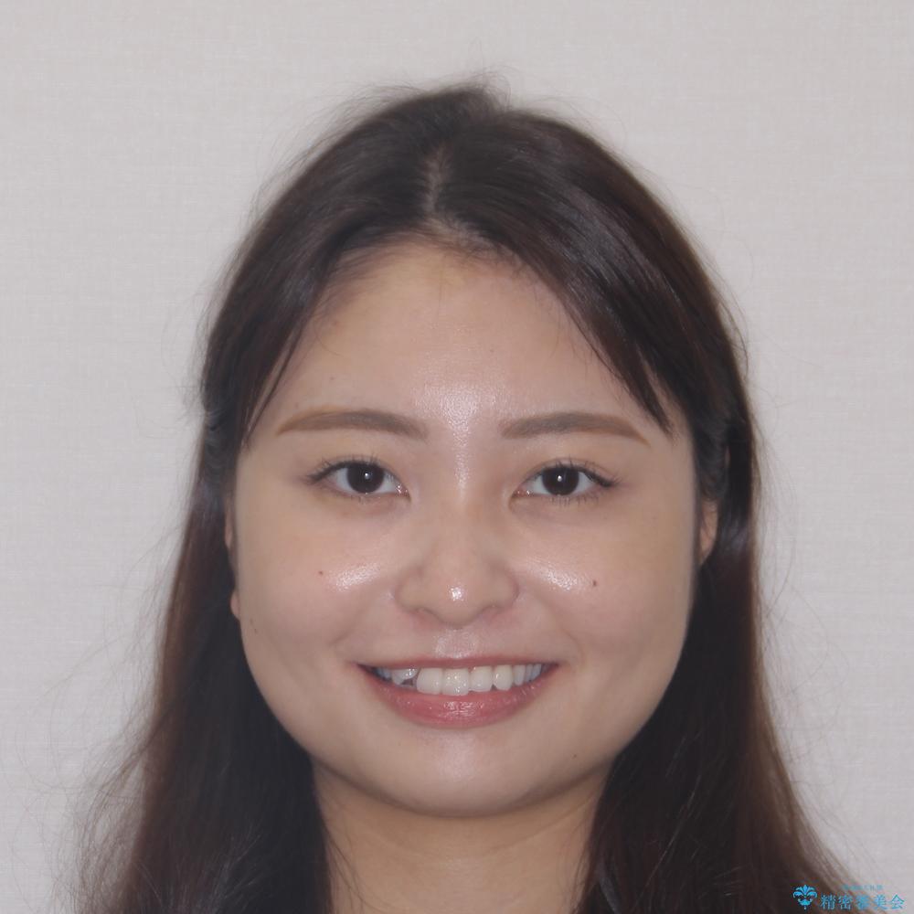 【モニター】八重歯と正中を改善 ワイヤー装置の抜歯矯正の治療前(顔貌)